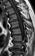 Diferenciální diagnostika o degenerativní onemocnění páteře spondylosa,