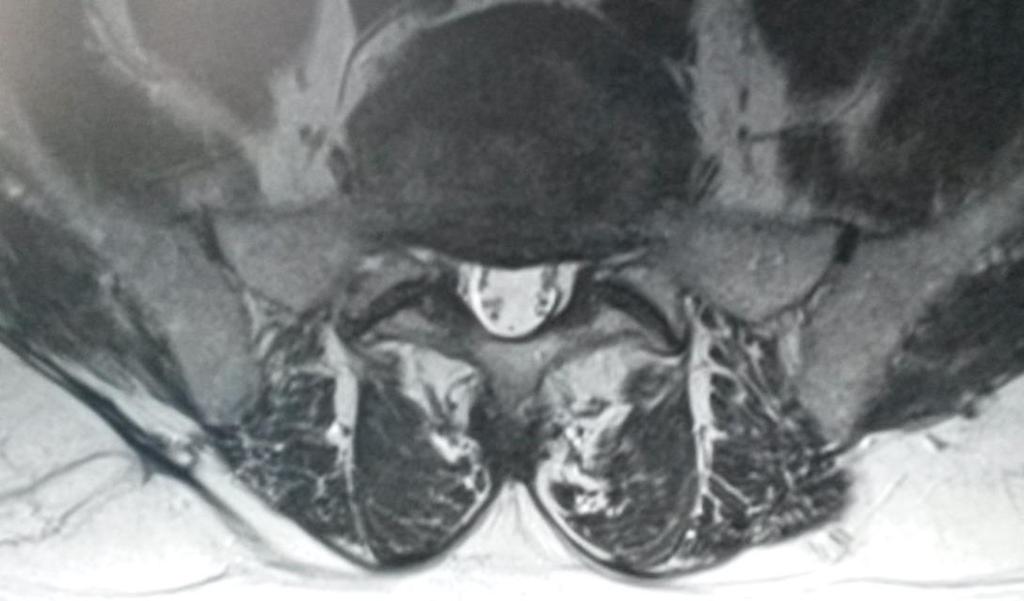 dorzální hernie disku L5/S1 s tlakem na durální vak, osteochondrosa L4/5 a L5/S1 (březen, 2014)