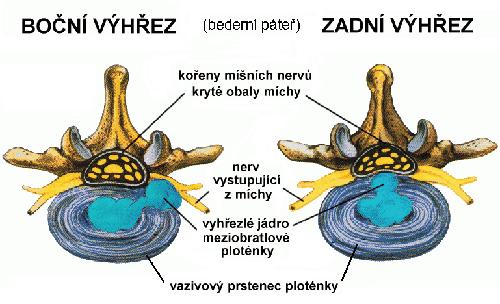 Obrázek č. 6: Hernie disku Zdroj: http://www.zbynekmlcoch.