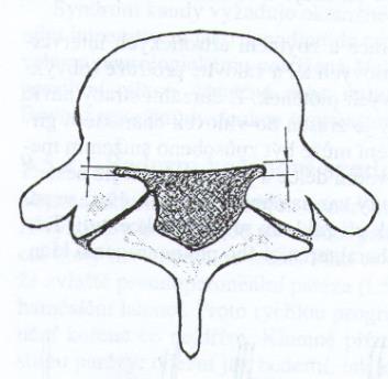 Obrázek č. 8: Zúžení páteřního kanálu Zdroj: (6) Obrázek č.