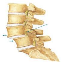 Obrázek č. 10: Spondylolistéza Zdroj: http://zdravachrbtica.