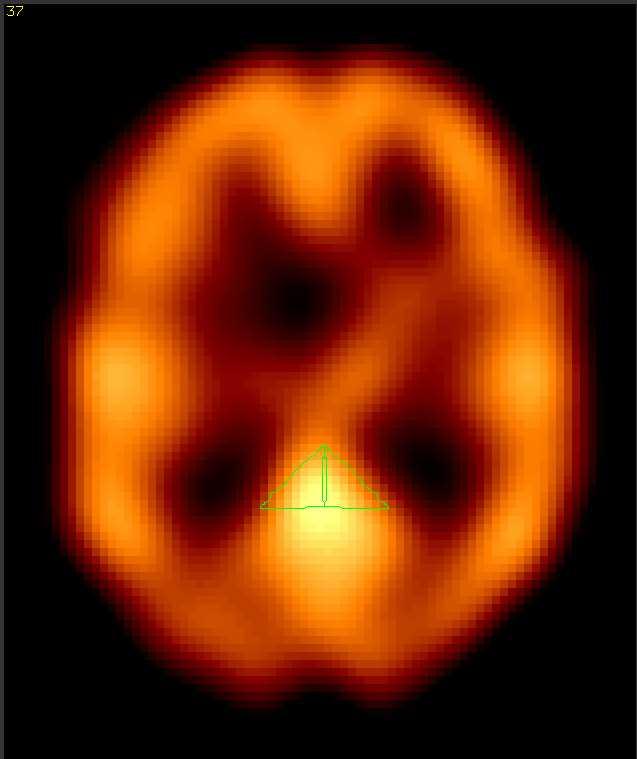 Na transverzalních řezech standardizovaných do Talairachova atlasu byly manuálně vykresleny oblasti zájmu - ROI (Region of Interest), zahrnující gyrus cinguli posterior l.sin, l.