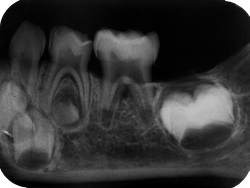 Rentgenové snímky pochází z Pohřebiště u kostela na Pohansku u Břeclavi (použité zkratky: D = dexter; S = sinister; MN = mandibula). Abb. 2.