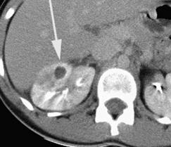 část ledviny diagnostika UZ, CT, ev.