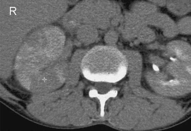 CT Akutní pyelonefritida (CT) zvětšení ledviny, zesílení Gerotovy fascie, prosáknutí tuku, tekutina