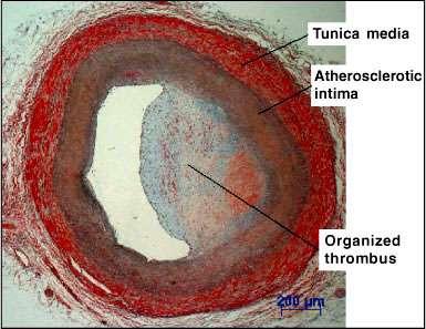 Etiopatogenéza arteriálnej trombózy biely, nástenný, doštičkový trombus - primárna patolog.