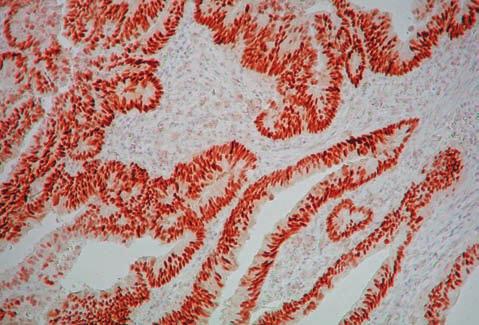 Imunohistochemická pozitivita tumor