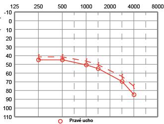 Intenzita v db Intenzita v db Frekvence v Hz o vzdušné vedení [ kostní vedení Pravé ucho Obrázek 6: Audiogram znázorňující percepční vadu sluchu na pravém uchu.