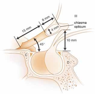 Perimetrie IV IV Obr.