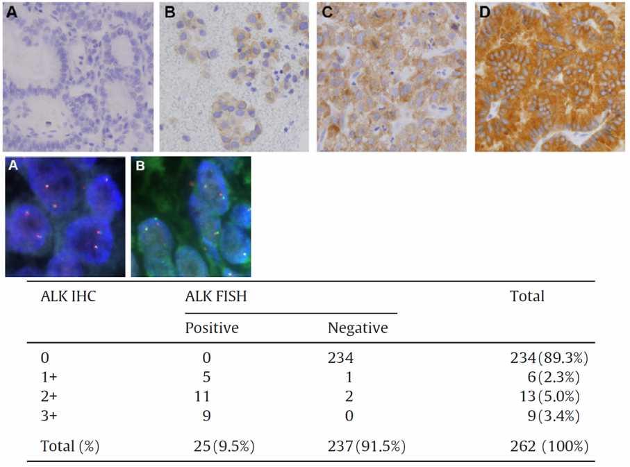 Novocastra, Clone 5A4, 1:5 dilution Bond Polymer Refine detection kit 262 patients, non-squamous cell histology 26 biopsies + 56