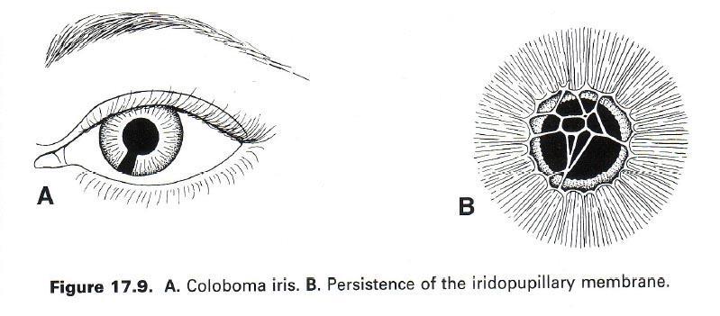 Vývojové vady vrozené odchlípení sítnice coloboma retinae (obvykle oboustranný porucha uzavírání fissura optica) cyclopia (1 oko), synophthalmia (splynulé oči) microphthalmia infekce anophthalmia