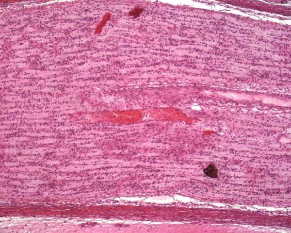 Nervus opticus výchlipka diencefala (thalamus opticus) axony odděleny endoneuriem