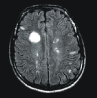 MRI 21 letého muže při první