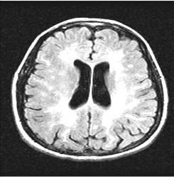 lesion burden T 1 BH lesion load Acute (new and Gd+) MRI activity Brain volume