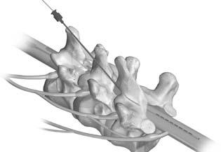 Umiestnenie perkutánnej elektródy v epidurálnom priestore VAROVANIE: Uhol zavádzacej ihly by mal byť 45 alebo menej.