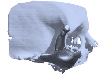 Speciální využití open cell foams vyrobené z titanové slitiny jsou části implantátů, kde díky pórovitosti kovové pěny dochází k zarůstání kosti do kovové