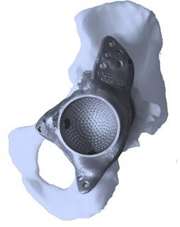 3 Lékařství Na základě 3D pacienta získaných pomocí CT nebo optického skenování je navržen 3D model implantátu, který přesně odpovídá potřebám pacienta.