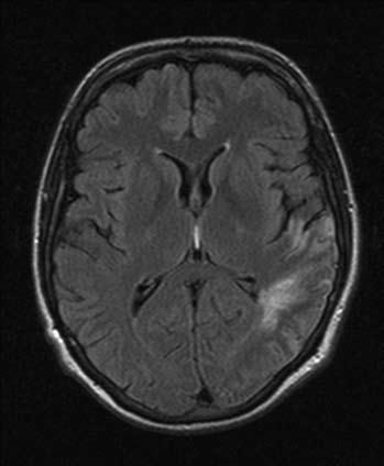 319 Obrázek 4A. MRI DWI sekvence: akutní infarkt v oblasti bazálních ganglií vlevo Obrázek 4B. MRA TOF sekvence: uzávěr M1 úseku ACM vlevo Obrázek 4C.
