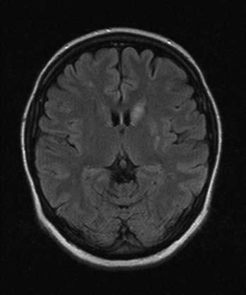 MRA TOF sekvence: stenózy karotického sifónu vpravo, M1 úseku ACM vlevo, A1 úseku ACA vpravo s gracilní pravou vertebrální tepnou nemocní po jednorázovém měření hladiny APA, jen 14 % zařazených osob