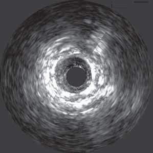 prokázala snížení výskytu in stent restenózy při IVUS vedené implantaci stentů do dlouhých lézí. Zejména výsledky studie RESIST, OPTICUS, Choi a kol.