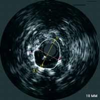 Všechny studie s IVUS vedenou implantací stentů prokázaly, že nejdůležitějším faktorem v predikci in stent restenózy je získaná plocha ve stentu (54), které lze dosáhnout jen dilatací vysokými tlaky.