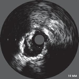 MLA ref symetrická expanze (min. SD/max. SD > 0,7) Obrázek 3. 3,5 mm stent dilatovaný deseti atmosférami, MSA je 6,1 mm2 Obrázek 6.