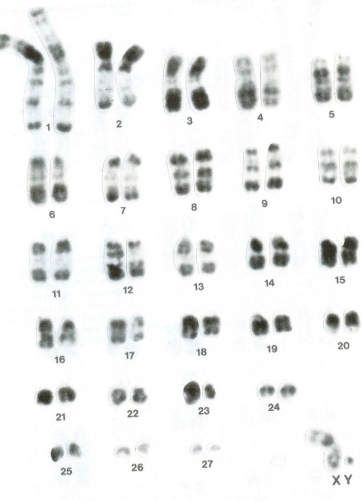 Proužkování chromozomů ( banding ) R-proužkování (reverse banding): denaturace při alkalickém působení za vysoké teploty