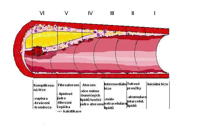 Fáze V: Vyznačuje se fibrózními lézemi typu 5b a 5c. Léze typu 5b se vyznačuje vyšším stupněm stenózy (zúžení) cévy, vyšším zastoupením hladkosvalových buněk a fibrózní tkáně.