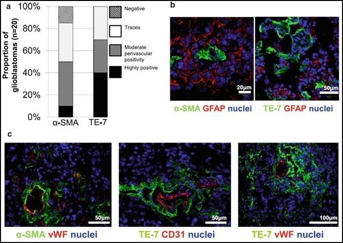 Nádor je složitým buněčným ekosystémem Nádorově asociované fibroblasty významně ovlivňují