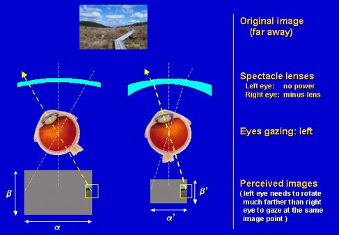 ANIZEIKONIE [dynamická anizeikonie/opticky indukovaná anizoforie] rozdílný poměr stranové rotace obou očí