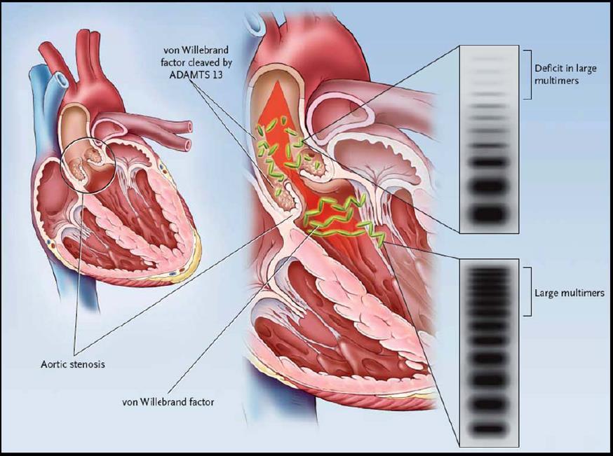Mechanismus získaného VWS u aortální stenózy Heyde s syndrom: *Heyde EC, NEJM 1958; 259: 196 Aortální stenóza GIT krvácení HMW