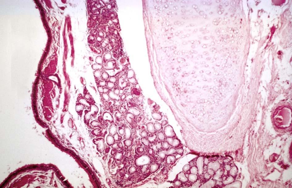 Intrapulmonální bronchus lumen