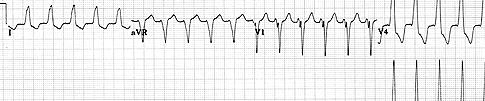 Fibrilace a flutter komor Fibrilace vlnky >300/min navazuje na komorovou extrasystolu, tachykardii nebo flutter fatální pokud nepřerušena ztráta vědomí (10s), smrt mozku (4-5min) Flutter vlnky