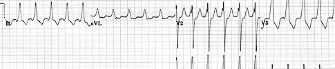 ! Vegetativní stimulace srdce A - adrenergní stimulace (SYMPATIKUS) 0-40 -80 čas (s) B1-receptor po otevření L-kanálů pro poca 2+ pacemakerové kanály pro kationty (zejm.