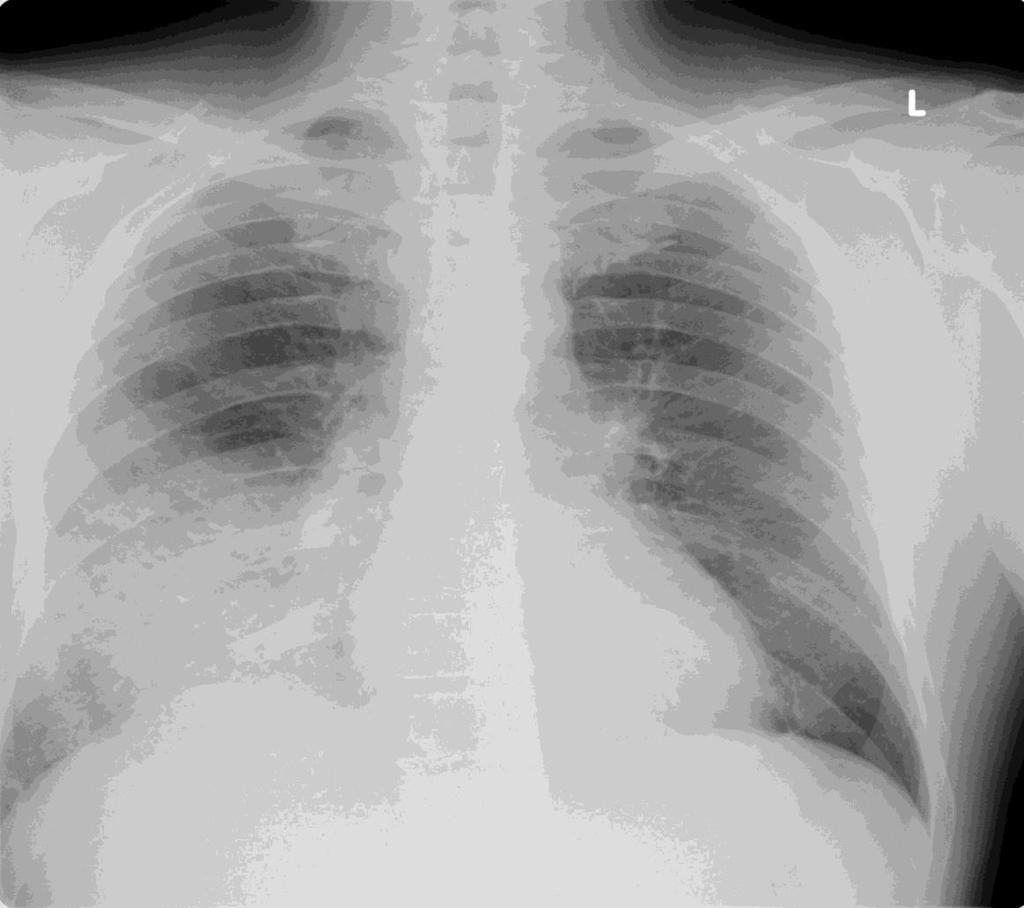 Příjem Fyzikální nález: Oslabené dýchání vpravo s chrůpky při bazích Laboratorní vyšetření: Leuko 14,3 10 9, Neu