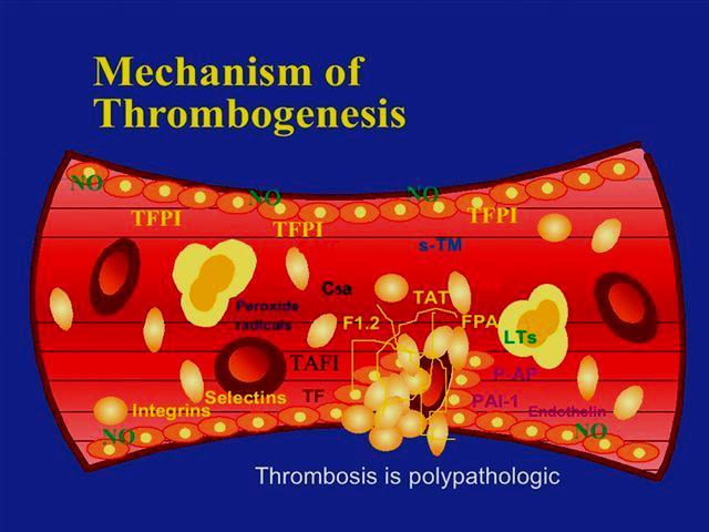 TROMBÓZA Bunkové, plazmatické, humoralne faktory Poškodenie endotelu