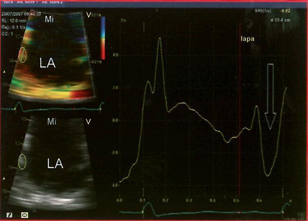 Echokardiografické hodnotenie funkcie ĽP tkanivový doppler-tdi strain myokardu zadnej steny ĽP -