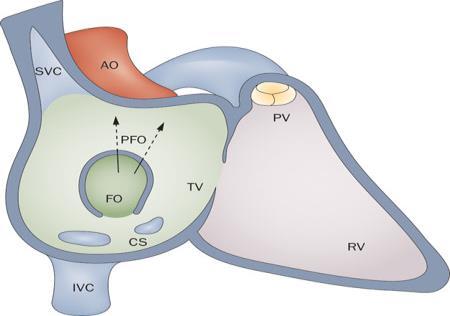 Patológia interátriálneho septa-skrat IAS Skrat IAS II.