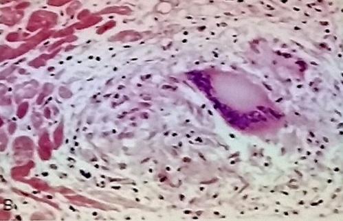 lymfatické uzliny Epiteloidní granulom tvořený jednojadernými a mnohojadernými histiocyty s jen malou příměsí lmfocytů, bez kaseifikačních nekróz sarkoidní granulom.