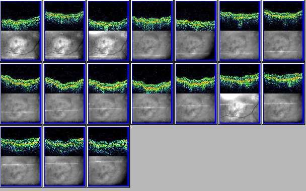 To je důležité, neboť orientace a lokalizace scanů dává rozdílné nálezy. Obr. 7. Průběh radial lines. Obr. 8. OCT skopie. Při vyhodnocování provádíme jednak kvalitativní, jednak kvantitativní analýzu.