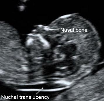 Příloha č. 2 Nuchal translucency na ultrazvukovém snímku http://www.google.cz/imgres?q=sn%c3%admek+plodu+se+zv%c3%bd %C5%A1en%C3%BDm+NT&hl=cs&client=firefoxa&hs=UK0&sa=X&rls=org.