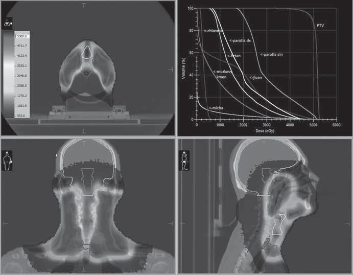 VI. RADIOTERAPEUTICKÉ METODY VI/ 43. PROTONOVÁ CHEMORADIOTERAPIE TECHNIKOU PENCIL BEAM SCANNING V LÉČBĚ NÁDORŮ HLAVY A KRKU S NUTNOSTÍ OZAŘOVÁNÍ BILATERÁLNÍCH KRČNÍCH UZLIN KUBEŠ J., DĚDEČKOVÁ K.