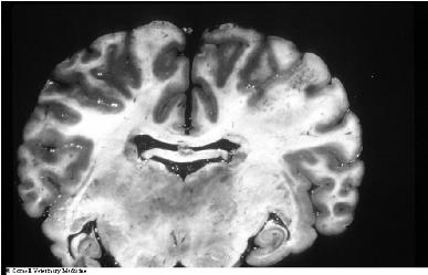 ELEM - CNS kůň Fumonisiny u člověka člověk -epidemiologické souvislosti s výskytem karcinomu jícnu studie z JAR a Číny dokumentují možnou roli a podíl vysokých dávek fumonisinů v etiologii nádorů