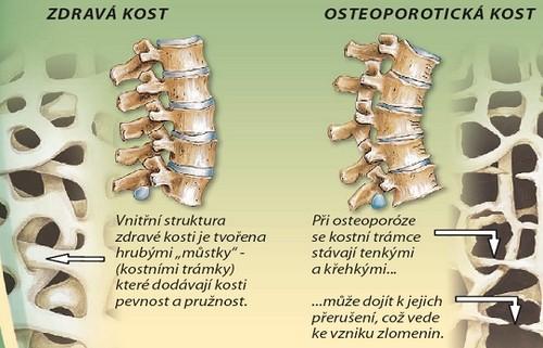5.2.2 Osteoporóza u muţů Muţi jsou vystaveni stejnému riziku osteoporózy jako ţeny, pouze její výskyt je u muţů niţší.