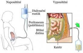 se ztrátami proteinů přes pobřišnici do dialyzačního roztoku; - vstřebávání nadměrného