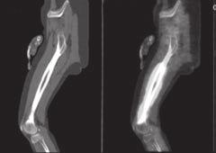 Obr. 3 Histologický nález velkobuněčný B lymfom Obr. 4 PET CT vyšetření ložiskové změny levého femuru statický proces, PET CT vyšetření se rovněž využívá v rámci diferenciální diagnostiky.