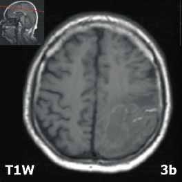 Vyšetření magnetickou rezonancí (MR) nemusí v hyperakutním stádiu vždy spolehlivě krvácení diagnostikovat (období oxyhemoglobinu), kdy se chová krev jako tekutina.