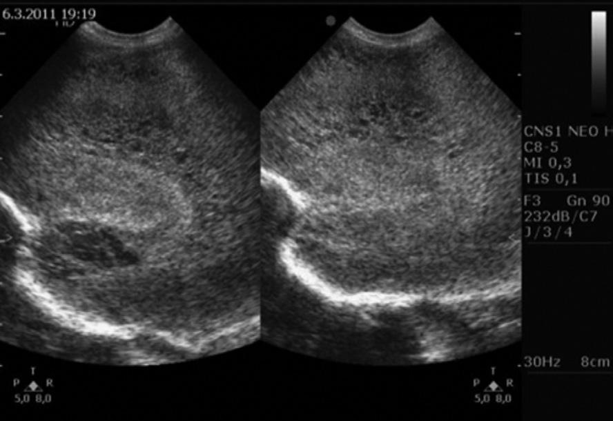 PERINATÁLNÍ ASFYXIE POST-RESUSCITAČNÍ PÉČE Obr. 12.2: Progrese hypoxicko-ischemické encefalopatie: vznik periventrikulárních cyst (temporookcipitálně).