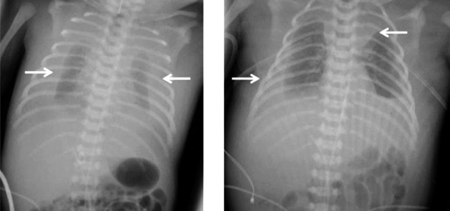 SPECIFICKÉ SITUACE S NUTNOSTÍ RESUSCITACE NA PORODNÍM SÁLE Obr. 14.2: Hydrops plodu: oboustranný fluidothorax (viz šipky) s hypoplazií plic.