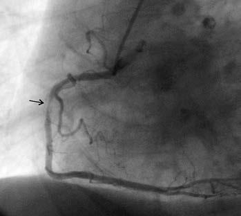 Obr. 1a. In-stent restenóza na pravé koronární tepně (šipka) Graf 1. Výsledný výskyt re-restenózy (reisr) v registru 100 80 60 40 8,2 % reisr 20 Obr. 1b.